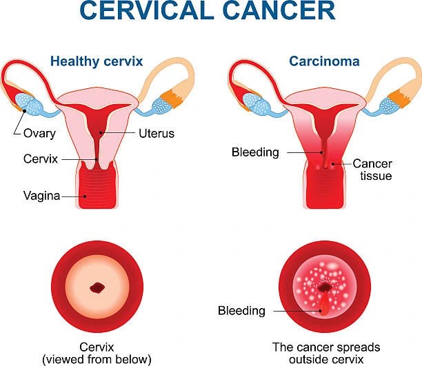 cervical cancer