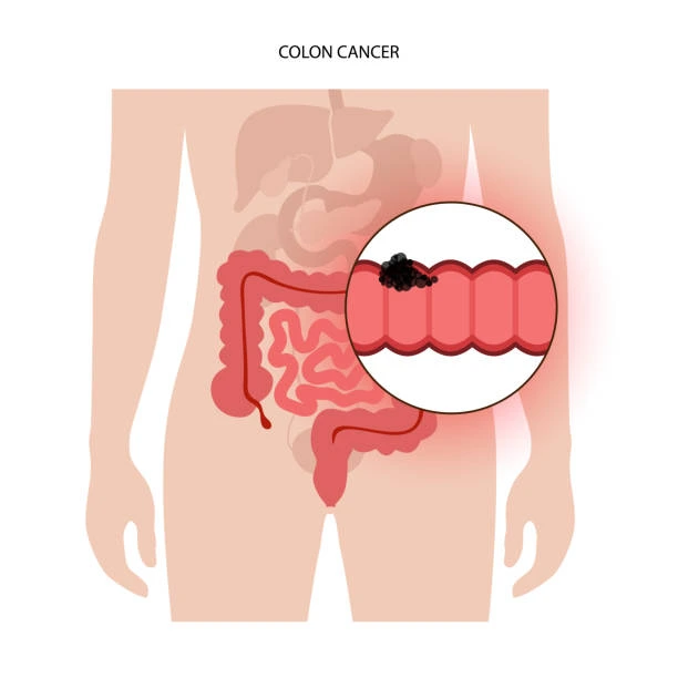 colorectal cancer
