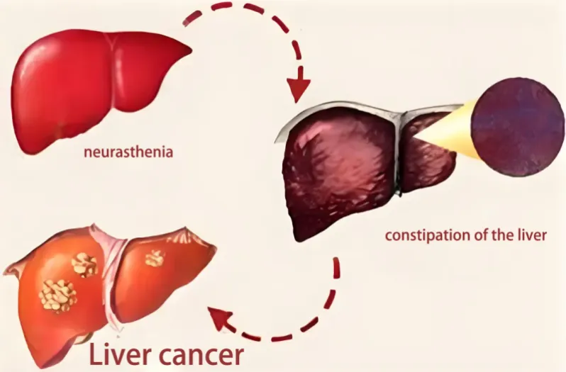 liver cancers