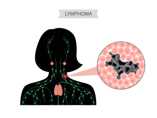 lymphoma