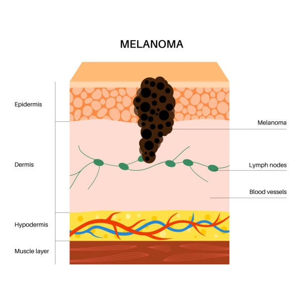 melanoma