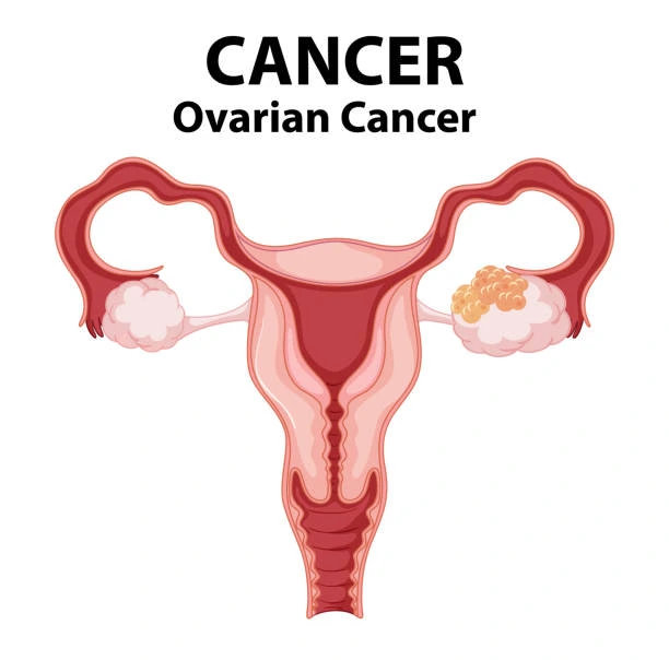 ovarian cancer