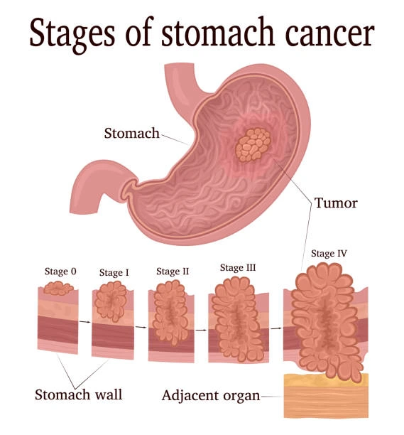 stomach cancer