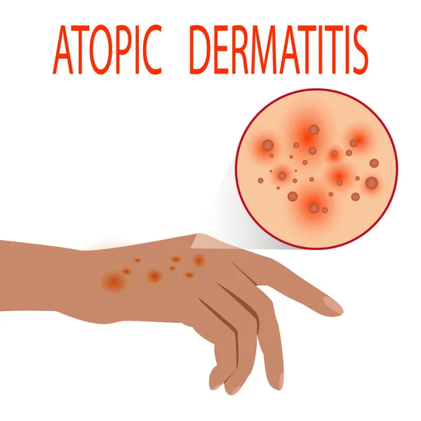 atopic dermatitis