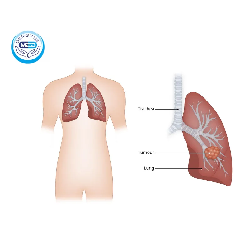 Dato DXd (ADC) Approved by U.S. FDA for Lung Cancer 2 lung cancer