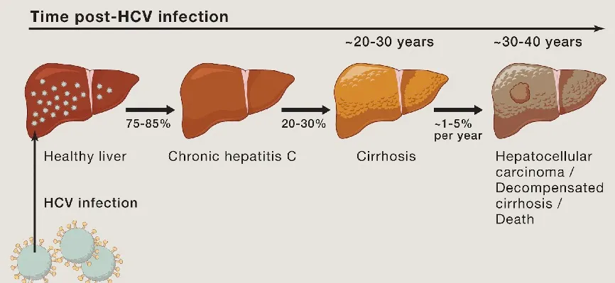 Is Chronic Hepatitis C Curable? Discover 6 Vital Facts 2 hcv infection