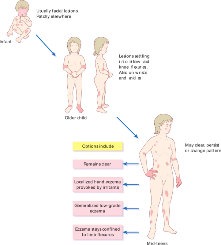 Unlock Calmer Skin: The Surprising Truth About What Triggers Atopic Dermatitis & 4 Inportant Tips 1 Pattern of atopic eczema varies with age