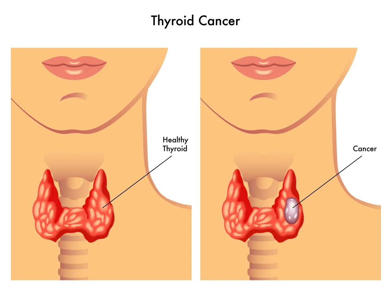 what is the most common cause of thyroid cancer