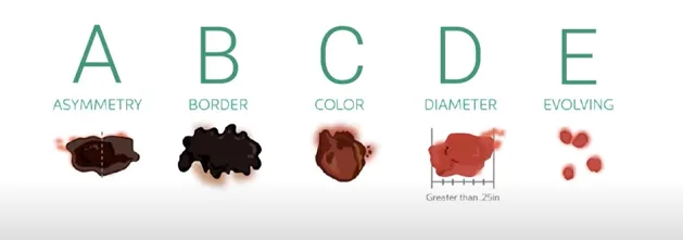 Is This Spot Dangerous? 5 Critical Melanoma Signs You Must Not Ignore 3 5 critical melanoma signs