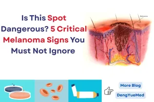 5 critical melanoma signs