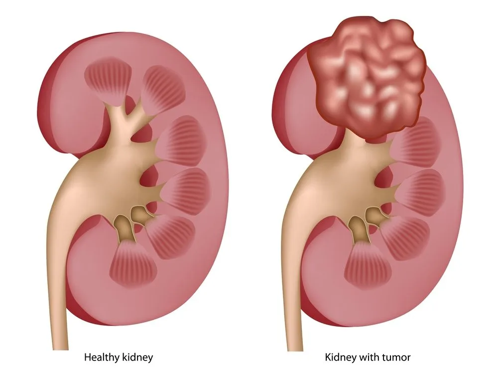 What Is the Main Cause of Kidney Cancer?Uncovering The Hidden Threat to Kidney Health 2 kidney cancer
