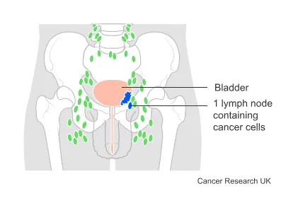 5 Stages of Bladder Cancer: What You Need to Know to Protect Your Health 2 node(n)
