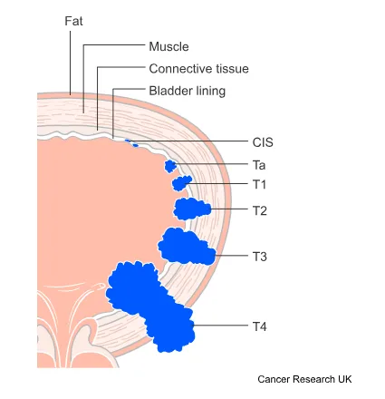 5 Stages of Bladder Cancer: What You Need to Know to Protect Your Health 1 tumour(t)