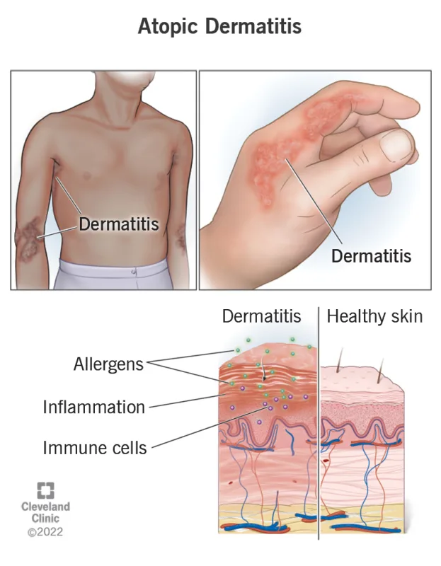 atopic dermatitis