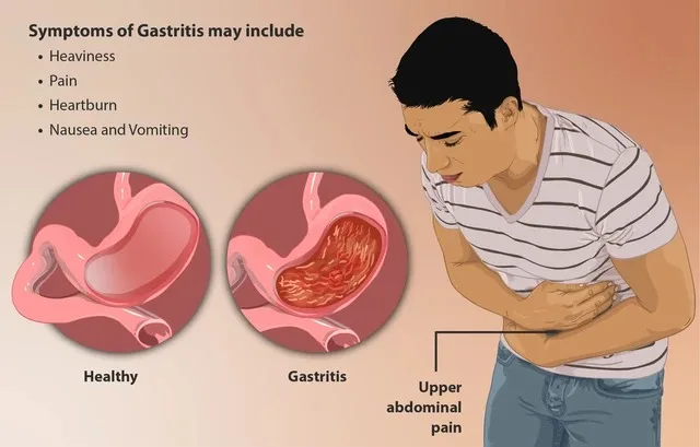 With 60% Affected by Gastritis, How to Shield Your Stomach Health 1 gastritis