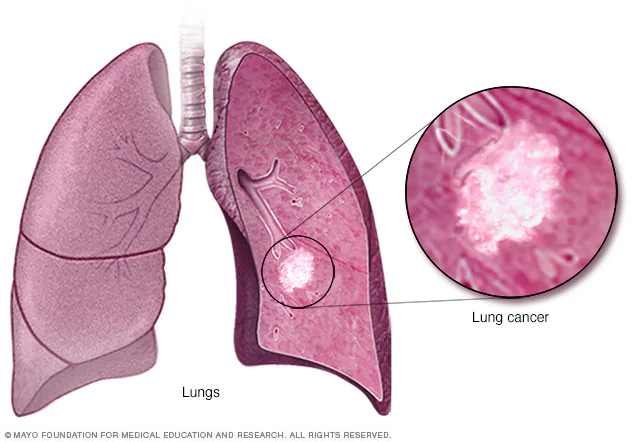 How Long Can Someone Live With Lung Cancer? Facts, Hope, and Factors That Influence Survival 1 lung cancer