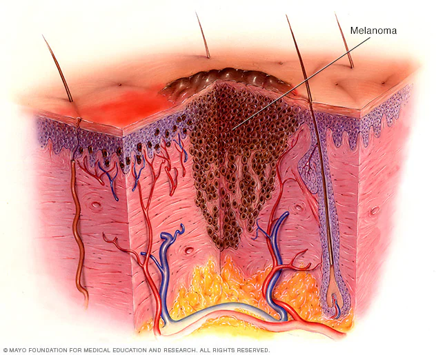 Is This Spot Dangerous? 5 Critical Melanoma Signs You Must Not Ignore 1 melanoma