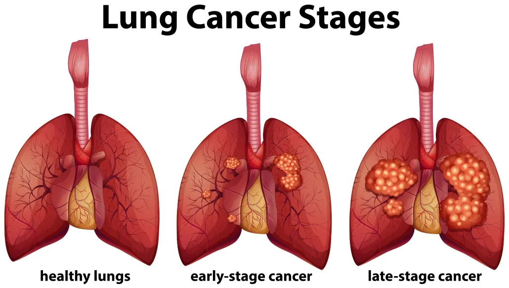 How Long Can Someone Live With Lung Cancer? Facts, Hope, and Factors That Influence Survival 2 stages of lung cancer