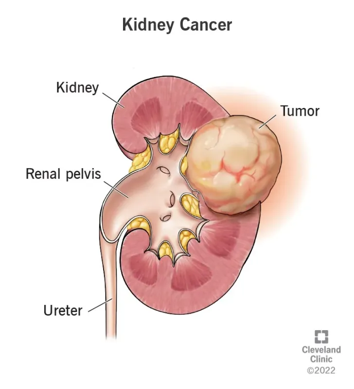 What Is the Main Cause of Kidney Cancer?Uncovering The Hidden Threat to Kidney Health 1 the main cause of kidney cancer