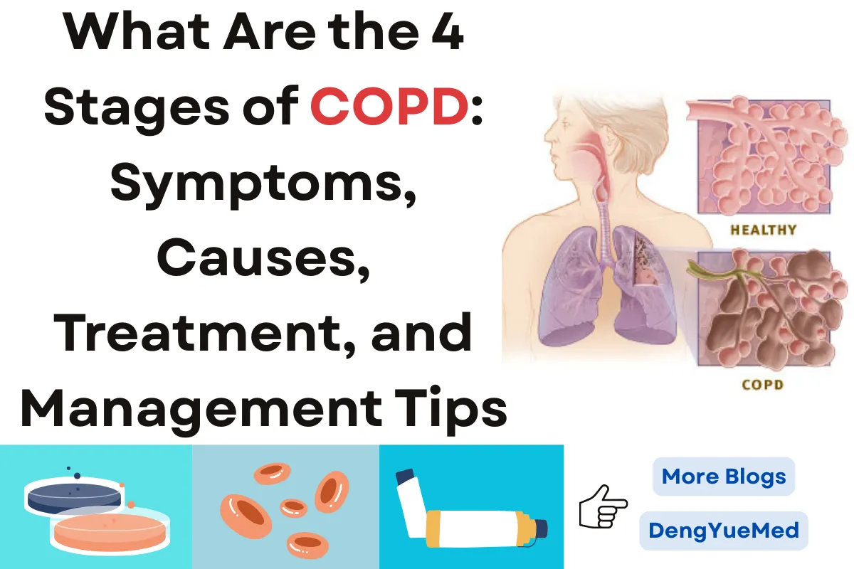 What Are the 4 Stages of COPD: Symptoms, Causes, Treatment, and Management Tips What Are the 4 Stages of COPD: Symptoms, Causes, Treatment, and Management Tips
