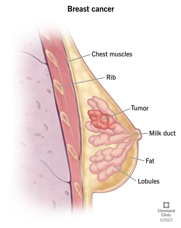 A Safer Approach to HDAC Inhibition: Chidamide (Epidaza) for Lymphoma and Breast Cancer 3 breast cancer