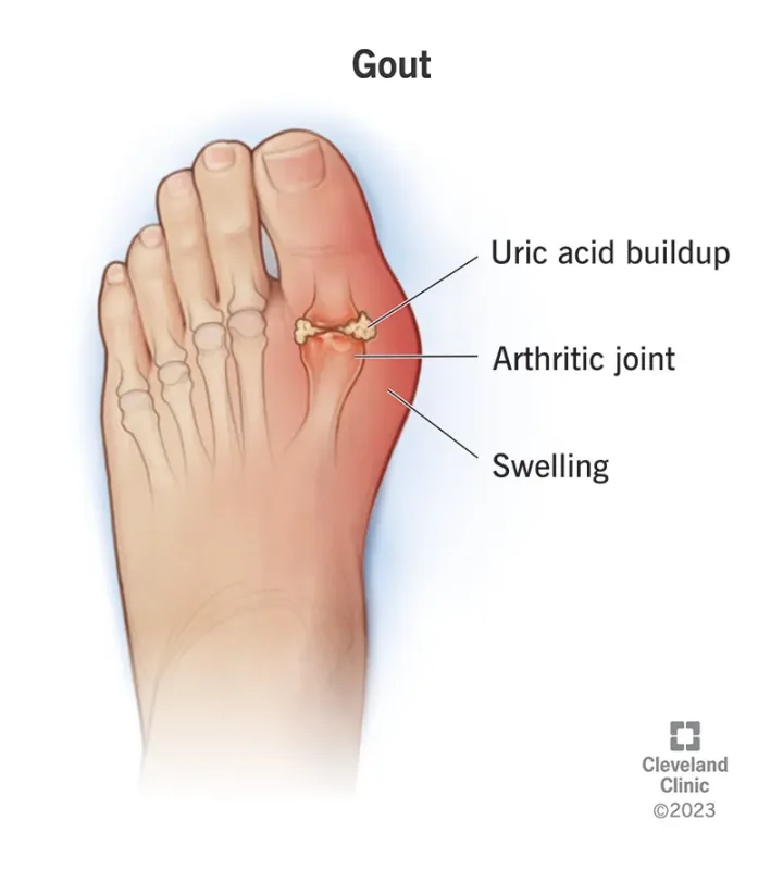 Gout arthritis
