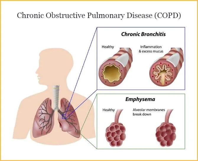 chronic obstructive pulmonary disease (copd)