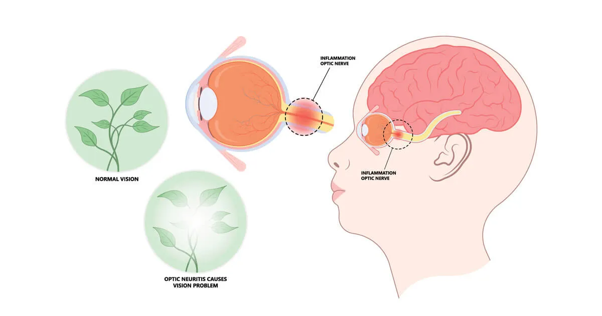 neuromyelitis optica spectrum disorder