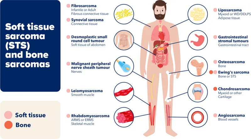 soft tissue sarcoma