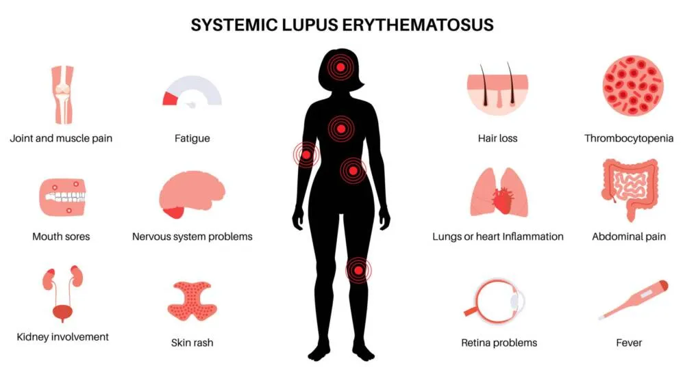 systemic lupus erythematosus