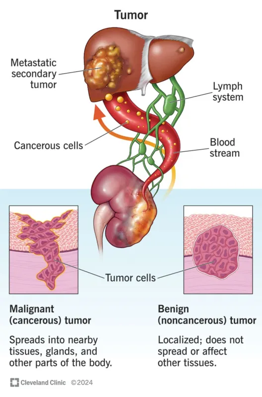 tumor