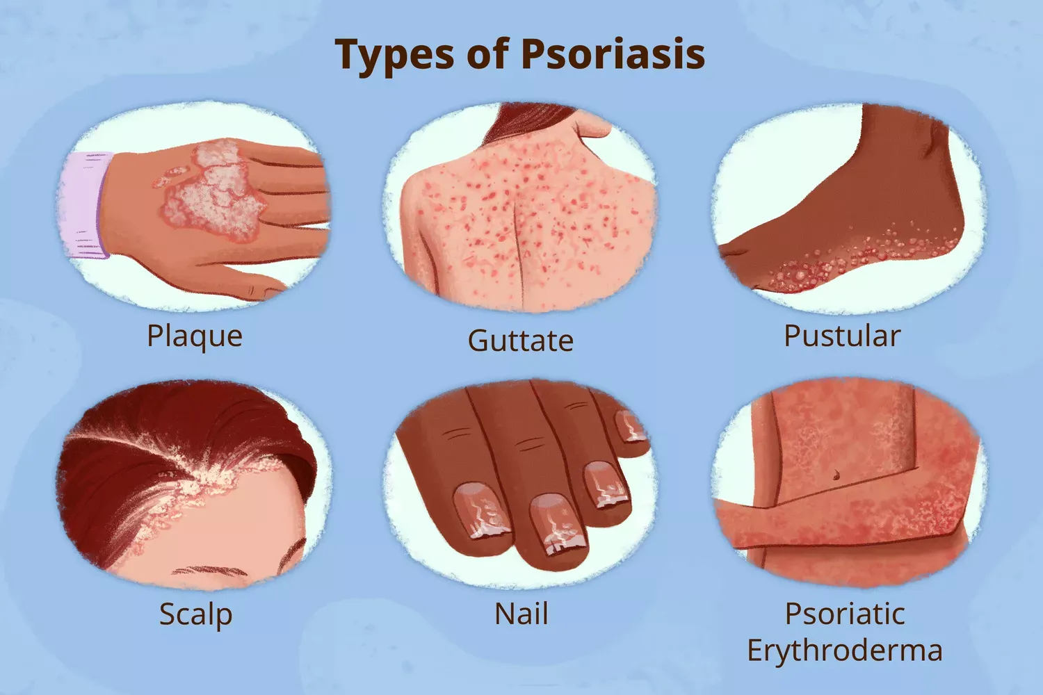 types of Psoriasis
