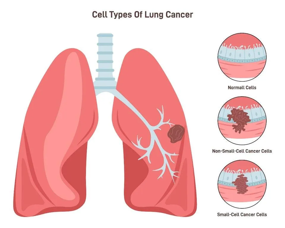Glumetinib Approval in China: A Major Breakthrough for MET-Positive Lung Cancer 3 types of lung cancer