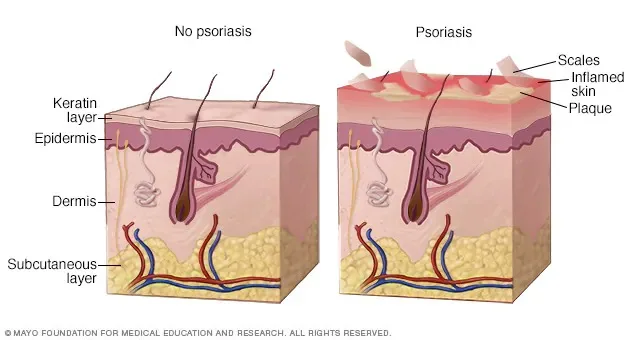 what causes plaque psoriasis