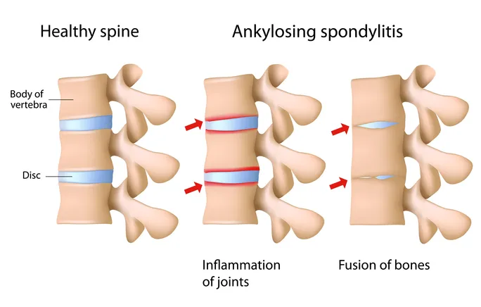 ankylosing spondylitis (AS)