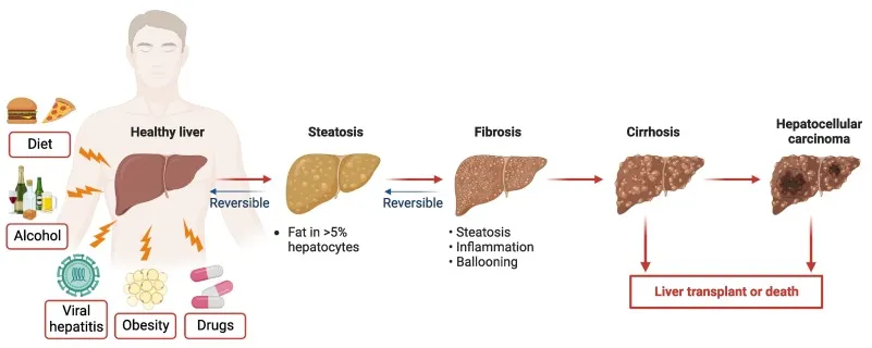chronic liver disease (CLD)
