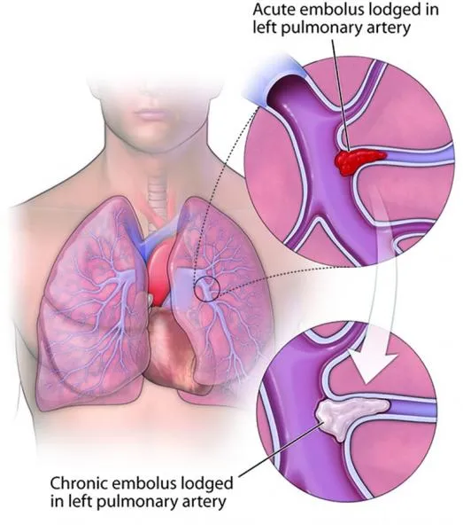 Pulmonary Hypertension Treatment: An In-Depth Look at What Riociguat Is Used For 3 chronic thromboembolic pulmonary hypertension (CTEPH)