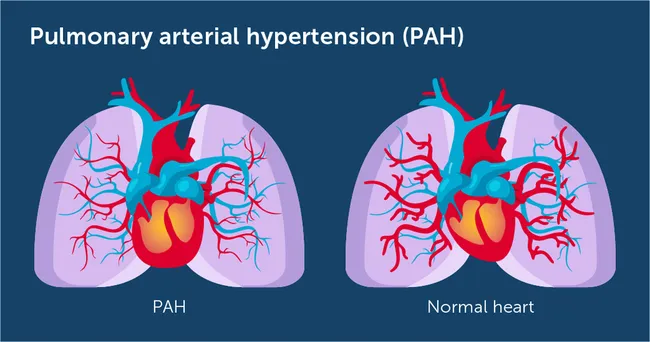 Pulmonary Hypertension Treatment: An In-Depth Look at What Riociguat Is Used For 4 pulmonary arterial hypertension PAH 2