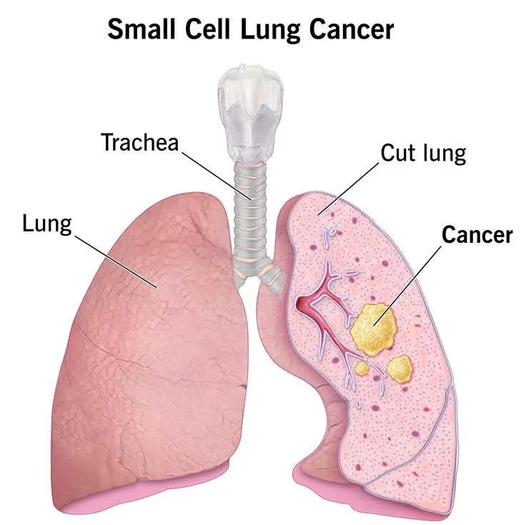 small cell lung cancer