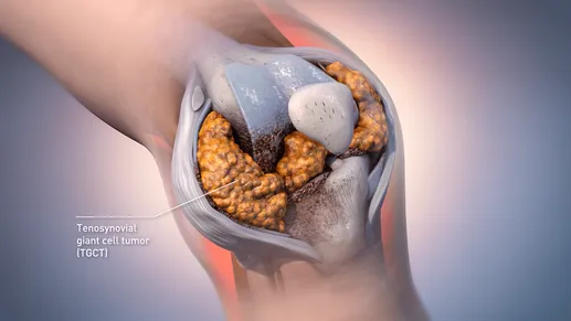 Abbisko’s Pimicotinib (ABSK021) for Tenosynovial Giant Cell Tumor: China’s First Class-1 CSF-1R Inhibitor Approved for TGCT 2 tenosynovial giant cell tumor