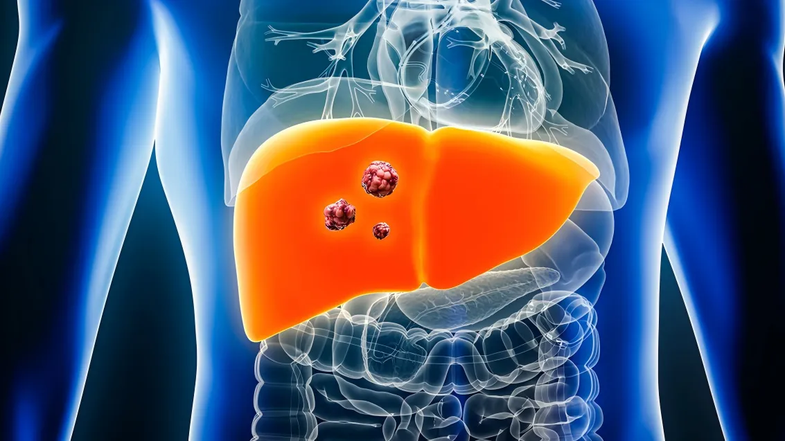 Which Cancers Does China Have Advantages In? Top 5 Areas of Strength Explained 1 liver cancer is one of chinas most globally influential strengths in cancer treatment