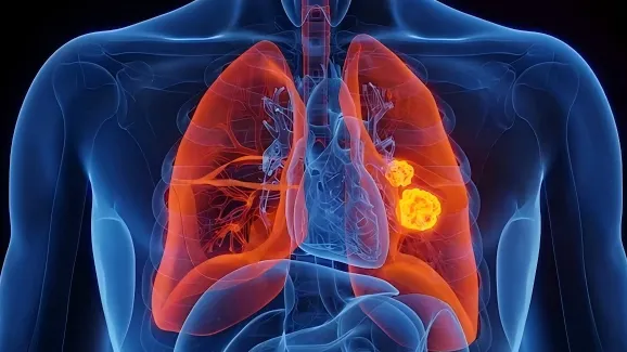 Which Cancers Does China Have Advantages In? Top 5 Areas of Strength Explained 5 lung cancer is a leading field representing the development of precision medicine in china