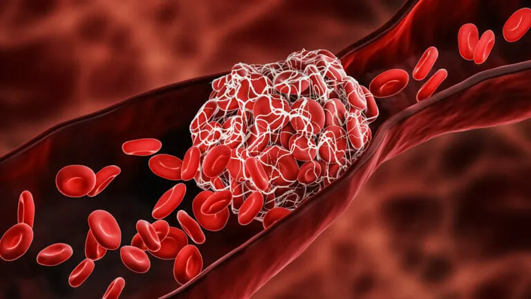 paroxysmal nocturnal hemoglobinuria pnh