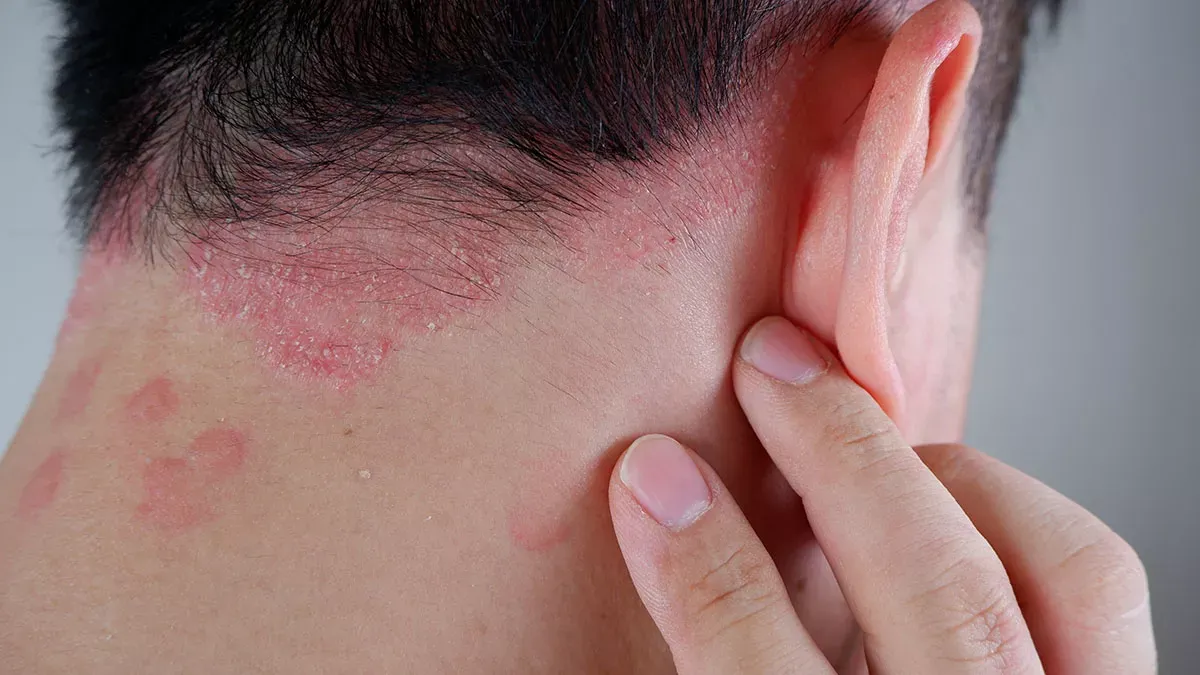 Gumokimab Approved for Plaque Psoriasis in China: The IL-17A Therapy Landscape Continues to Evolve 2 plaque psoriasis