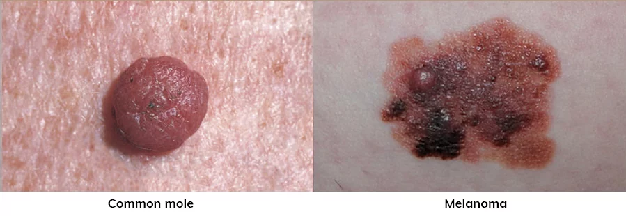 common mole vs melanoma