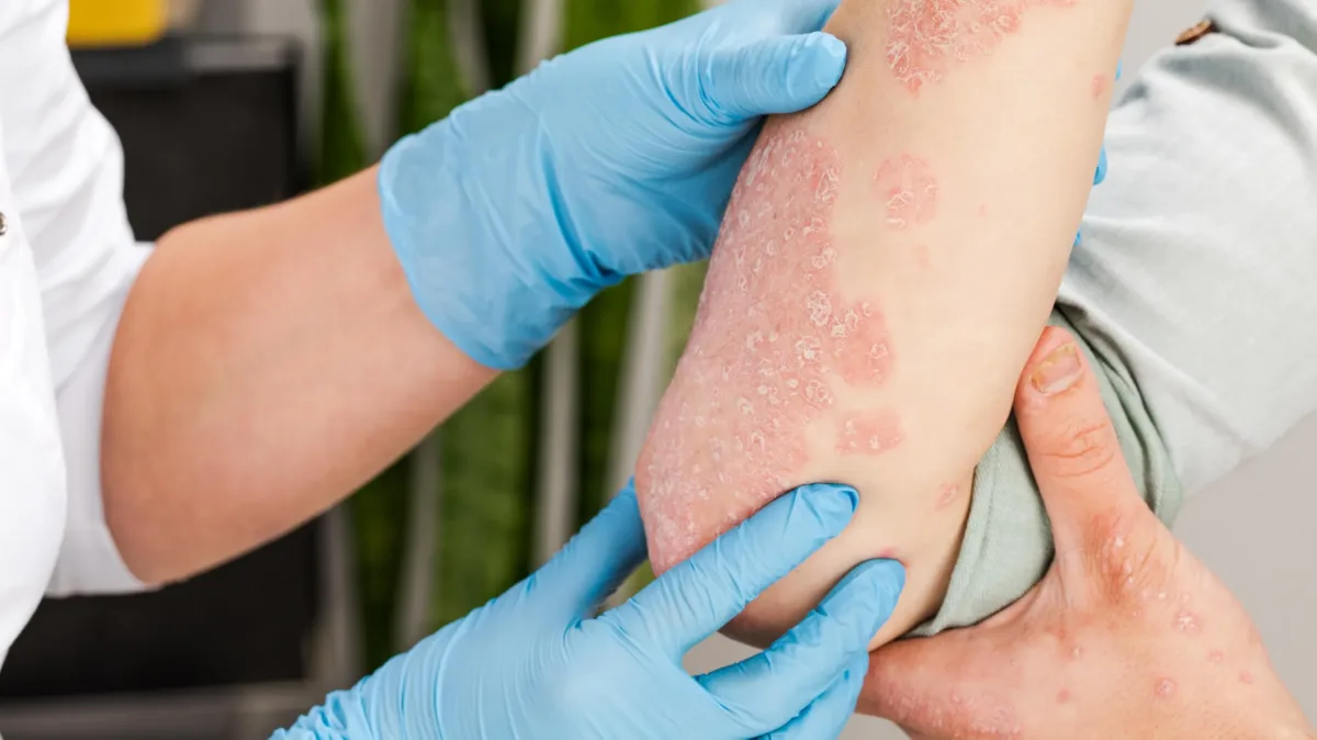 generalized pustular psoriasis gpp