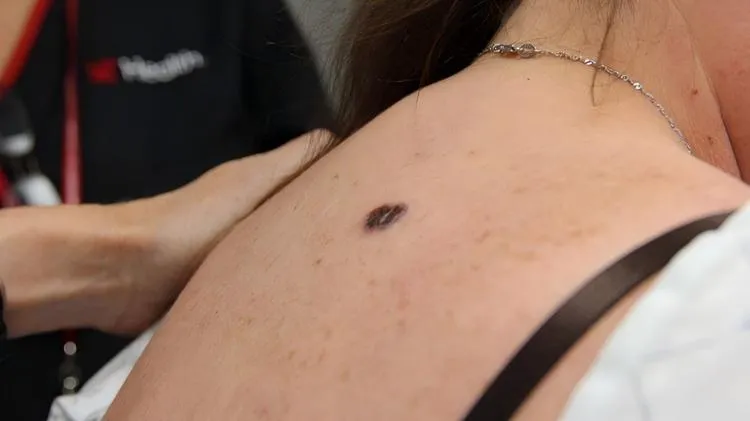 melanoma